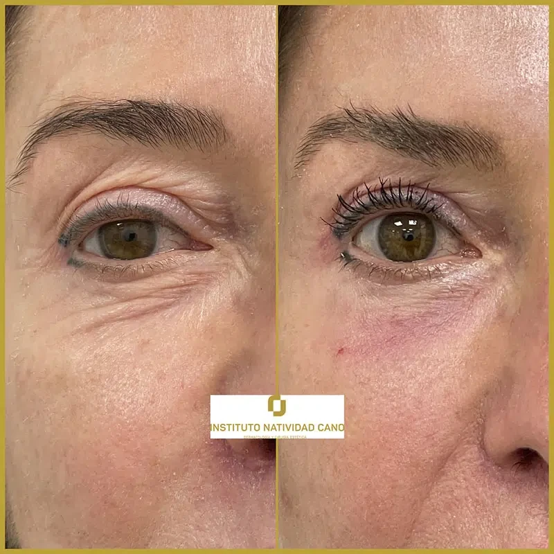 Tratamiento con Láser CO2: rejuvenecimiento facial y eliminación de imperfecciones cutáneas