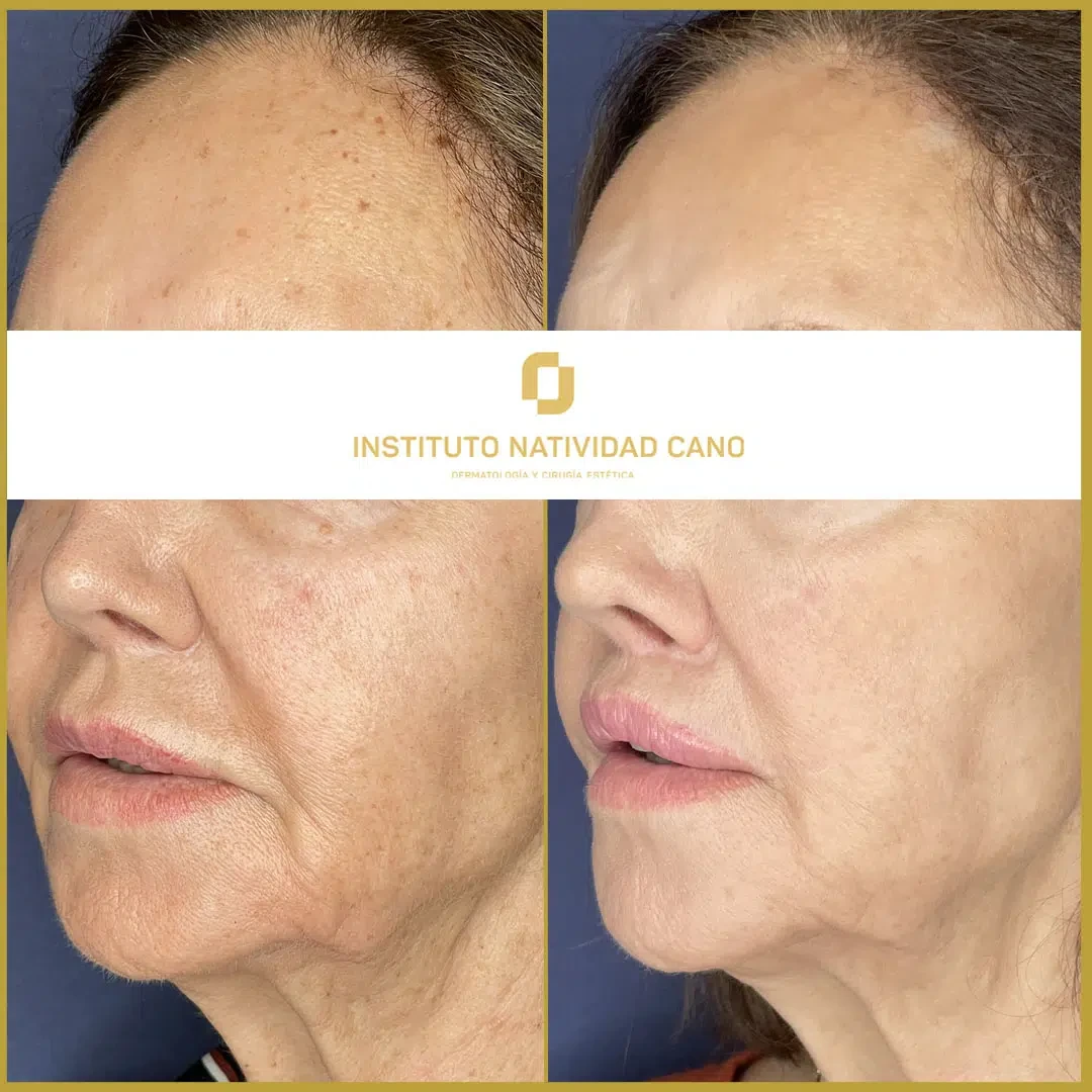 Lip Lift indirecto - Caso 2 - Izquierda