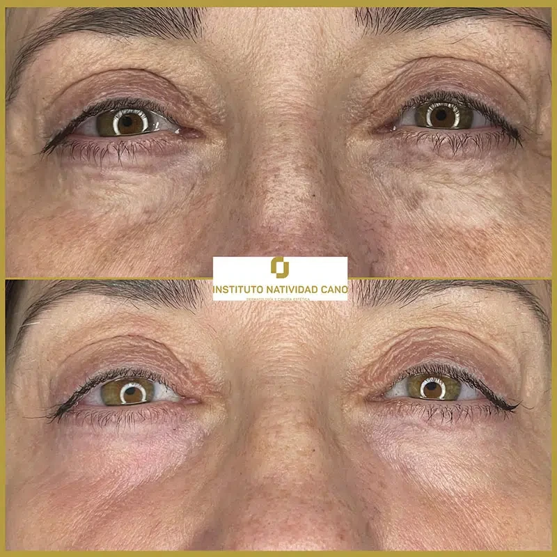 Tratamiento con Láser CO2: rejuvenecimiento facial y eliminación de imperfecciones cutáneas