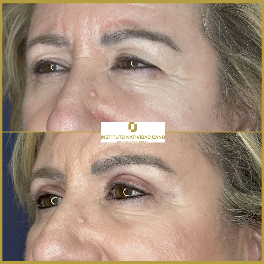 BLEFAROPLASTIA SUPERIOR Y LIFTING DE CEJAS-Caso 2-Izquierda