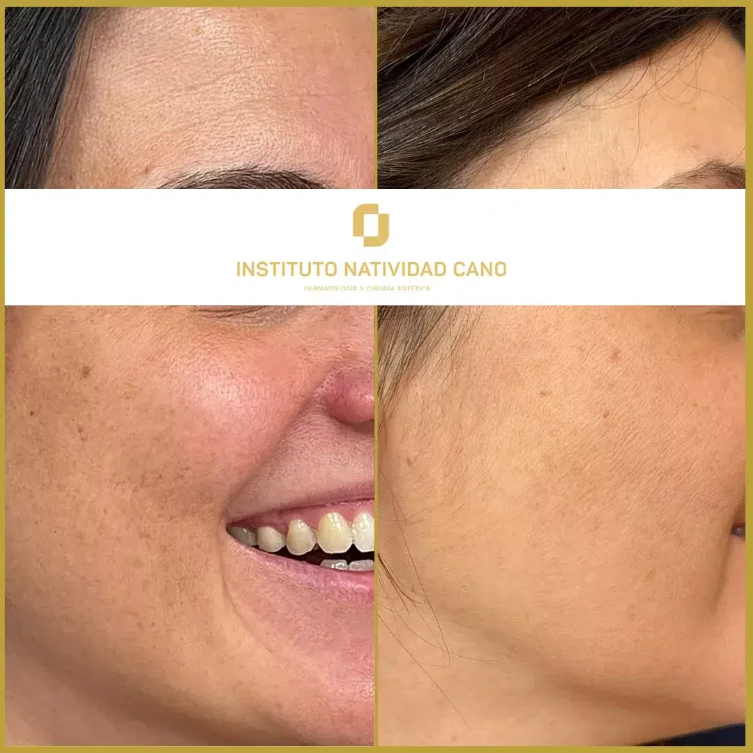 Tratamiento para el melasma - piel sana