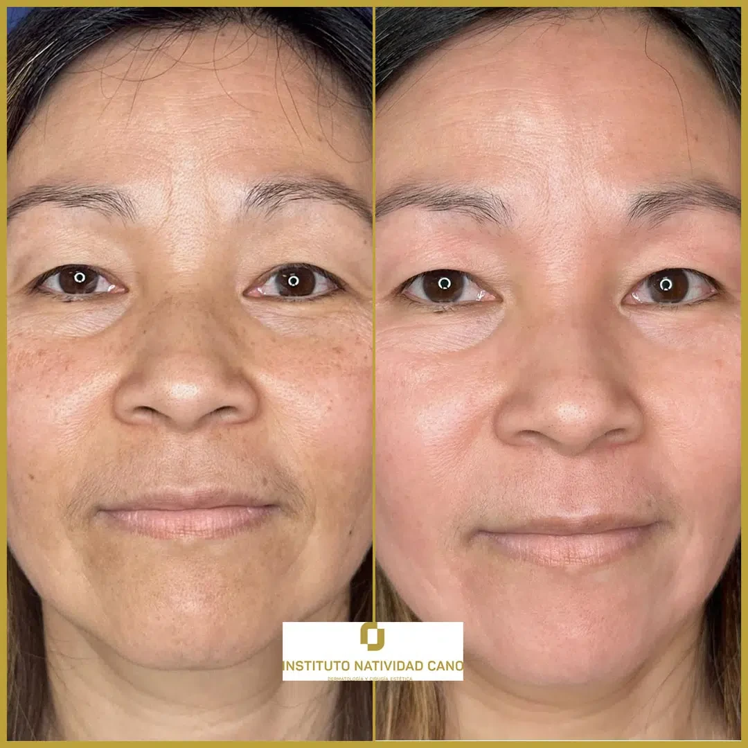 Tratamiento del melasma frente caso 1