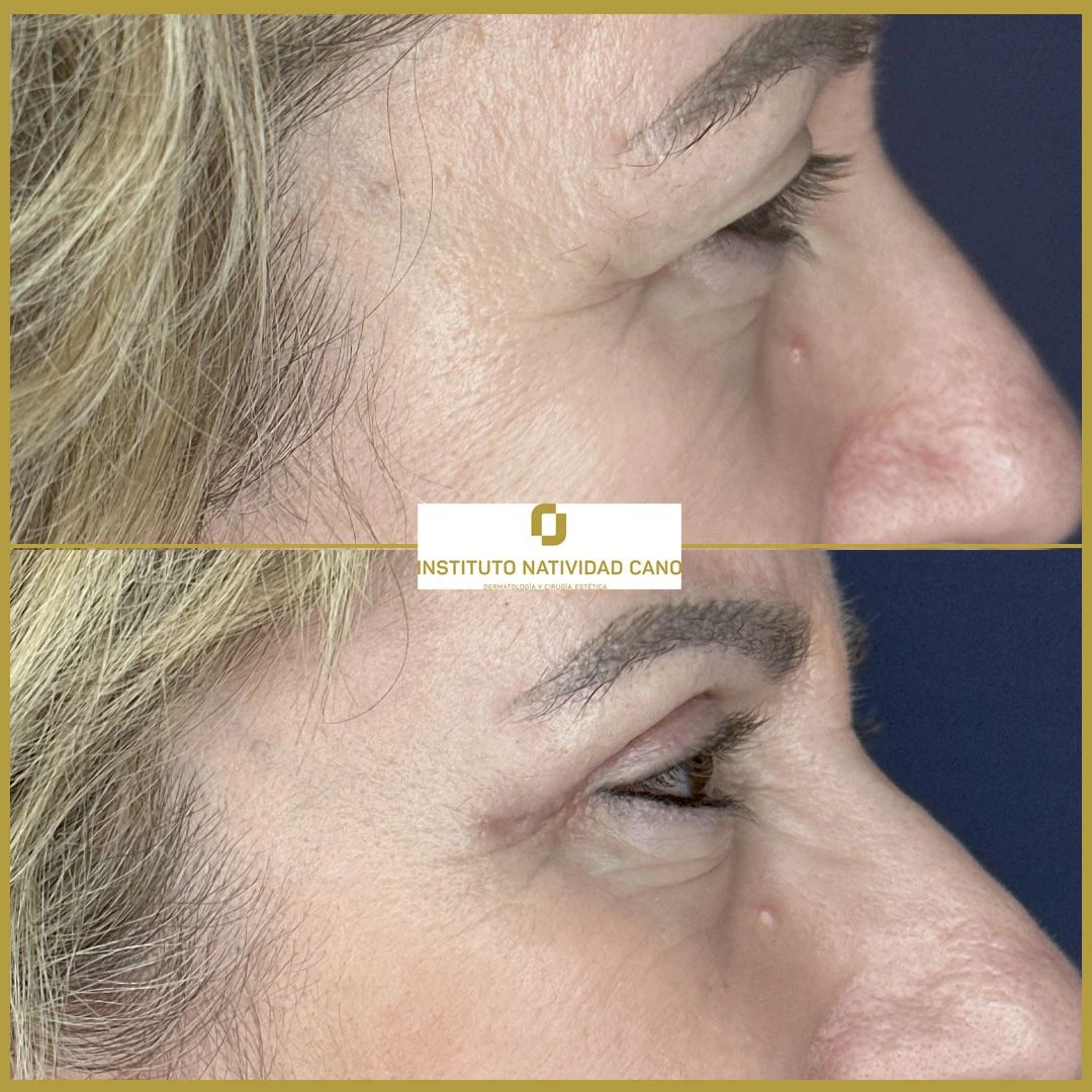 BLEFAROPLASTIA SUPERIOR Y LIFTING DE CEJAS-Caso 2-Derecha perfil