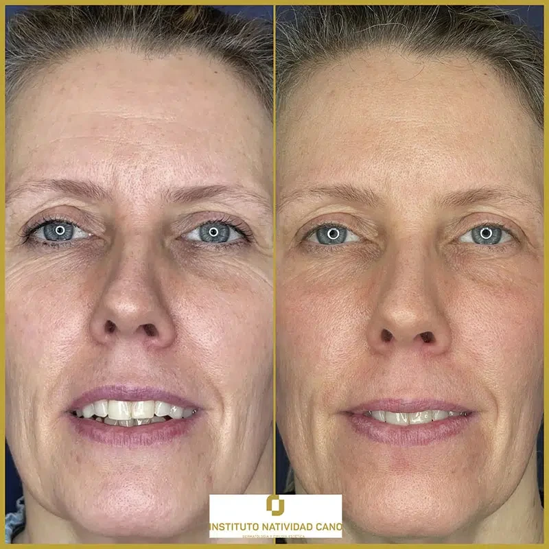 Tratamiento con Láser CO2: rejuvenecimiento facial y eliminación de imperfecciones cutáneas