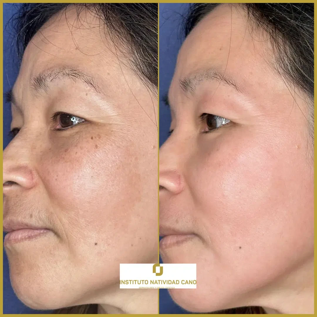 Tratamiento del melasma izquierda caso 1