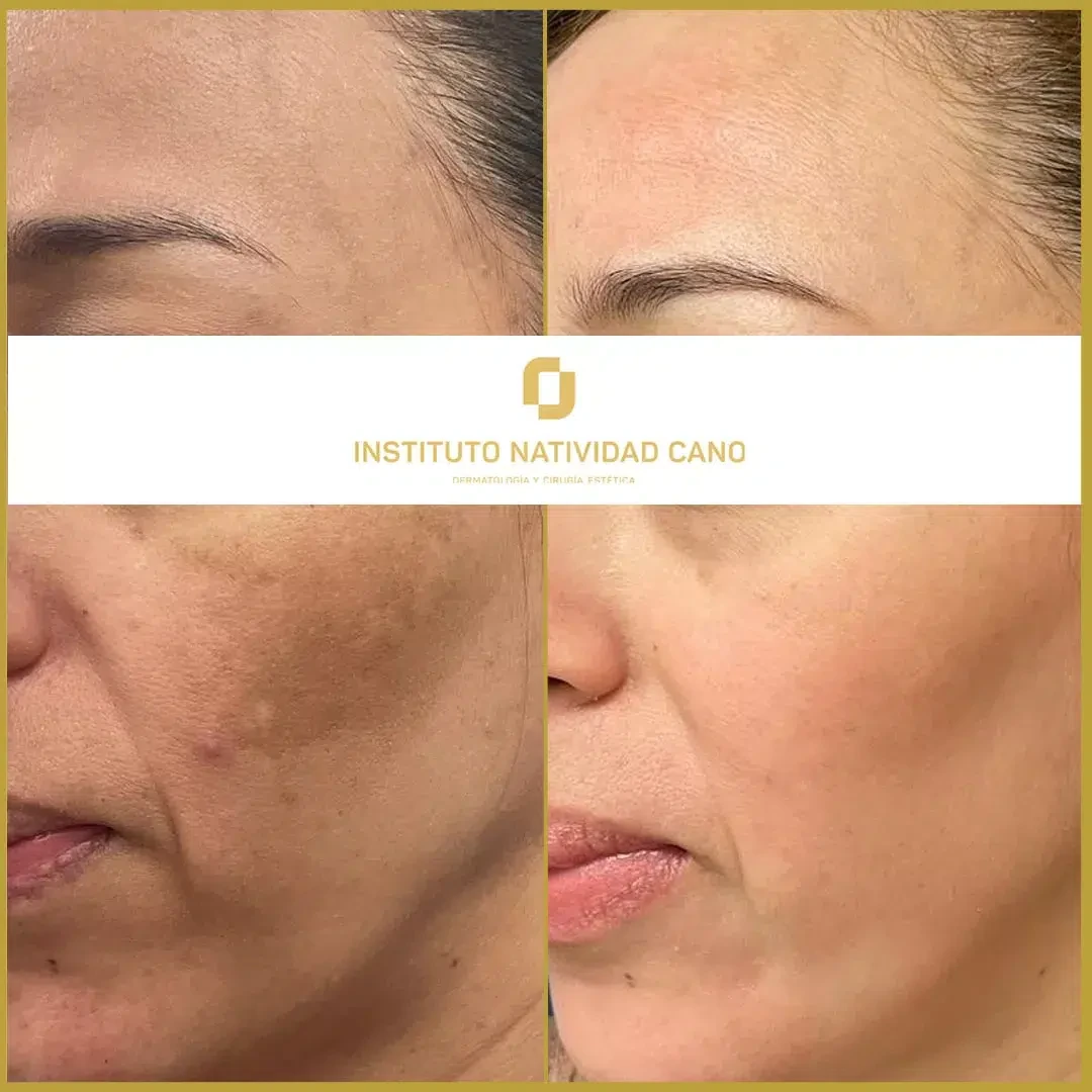 Tratamiento para el melasma - piel sana