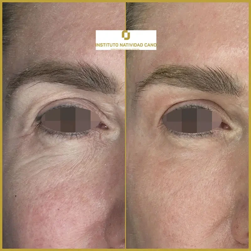 Tratamiento con Láser CO2: rejuvenecimiento facial y eliminación de imperfecciones cutáneas