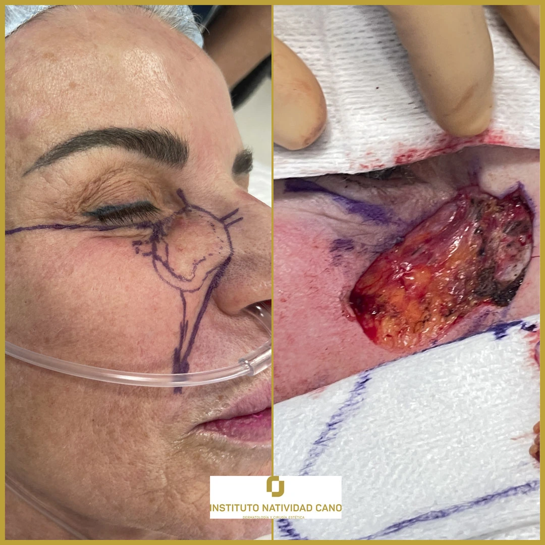 Cáncer de piel - Cirugía micrográfica de Mohs - Caso 2-Fronta