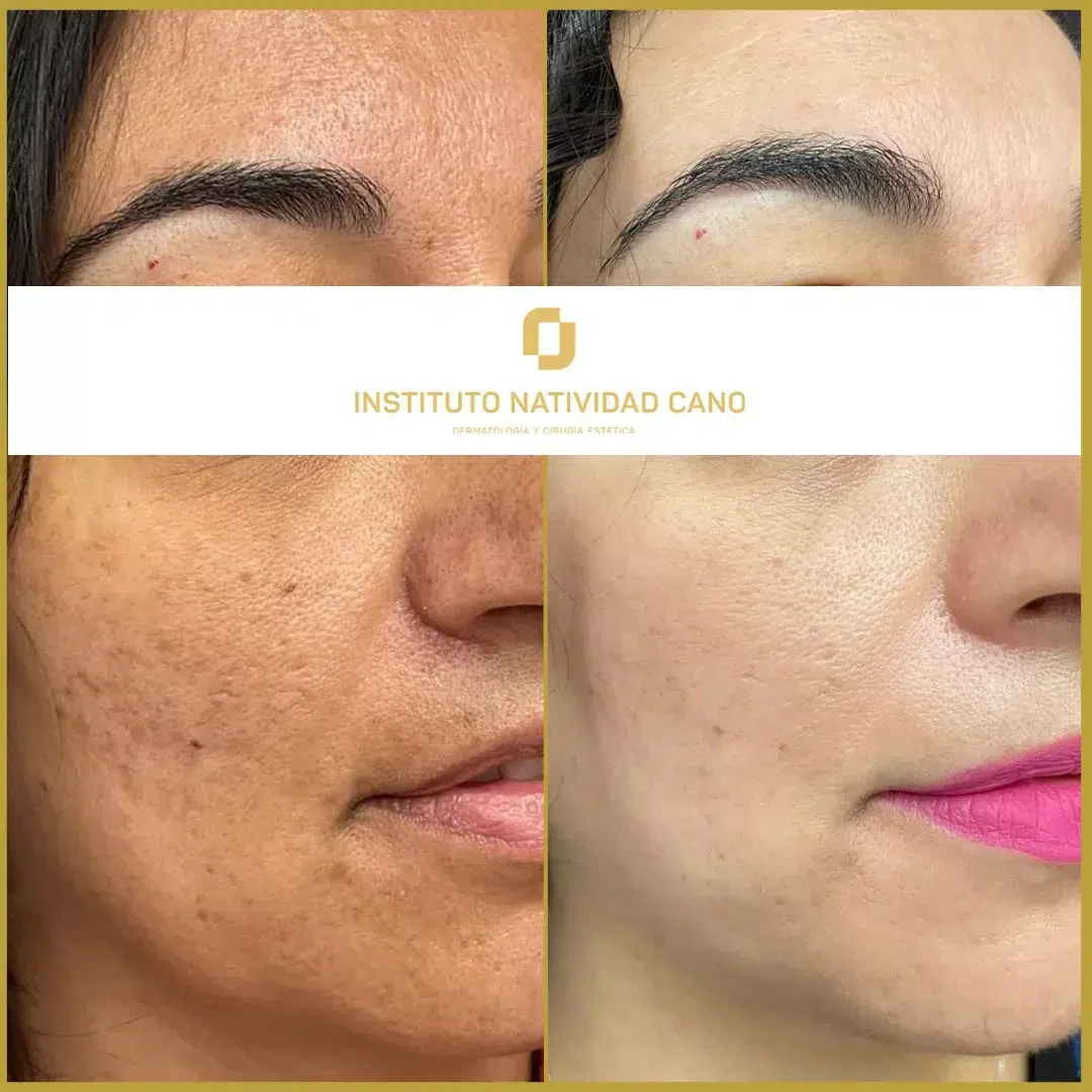 Tratamiento para el melasma - piel sana