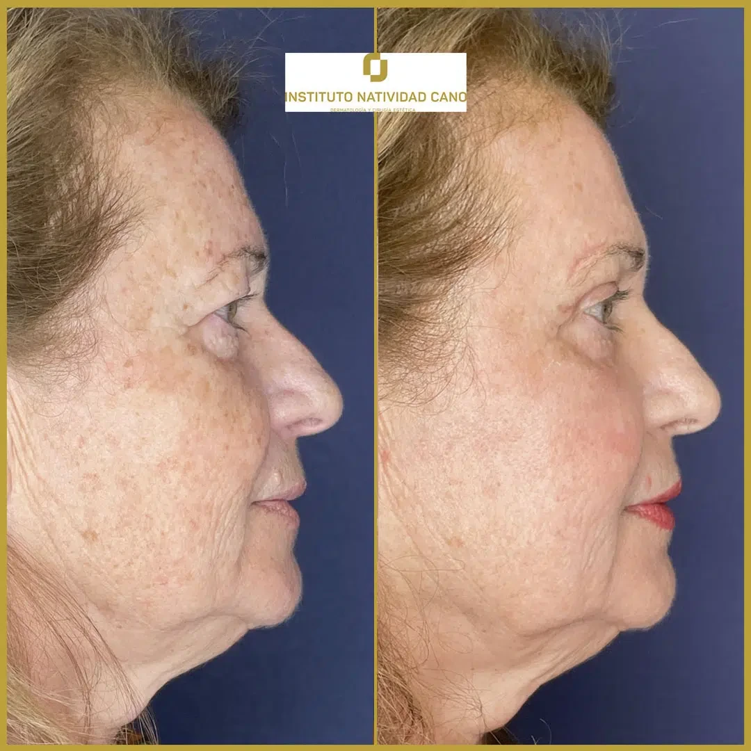 Tratamiento mirada-Blefaroplastia Caso 2-d