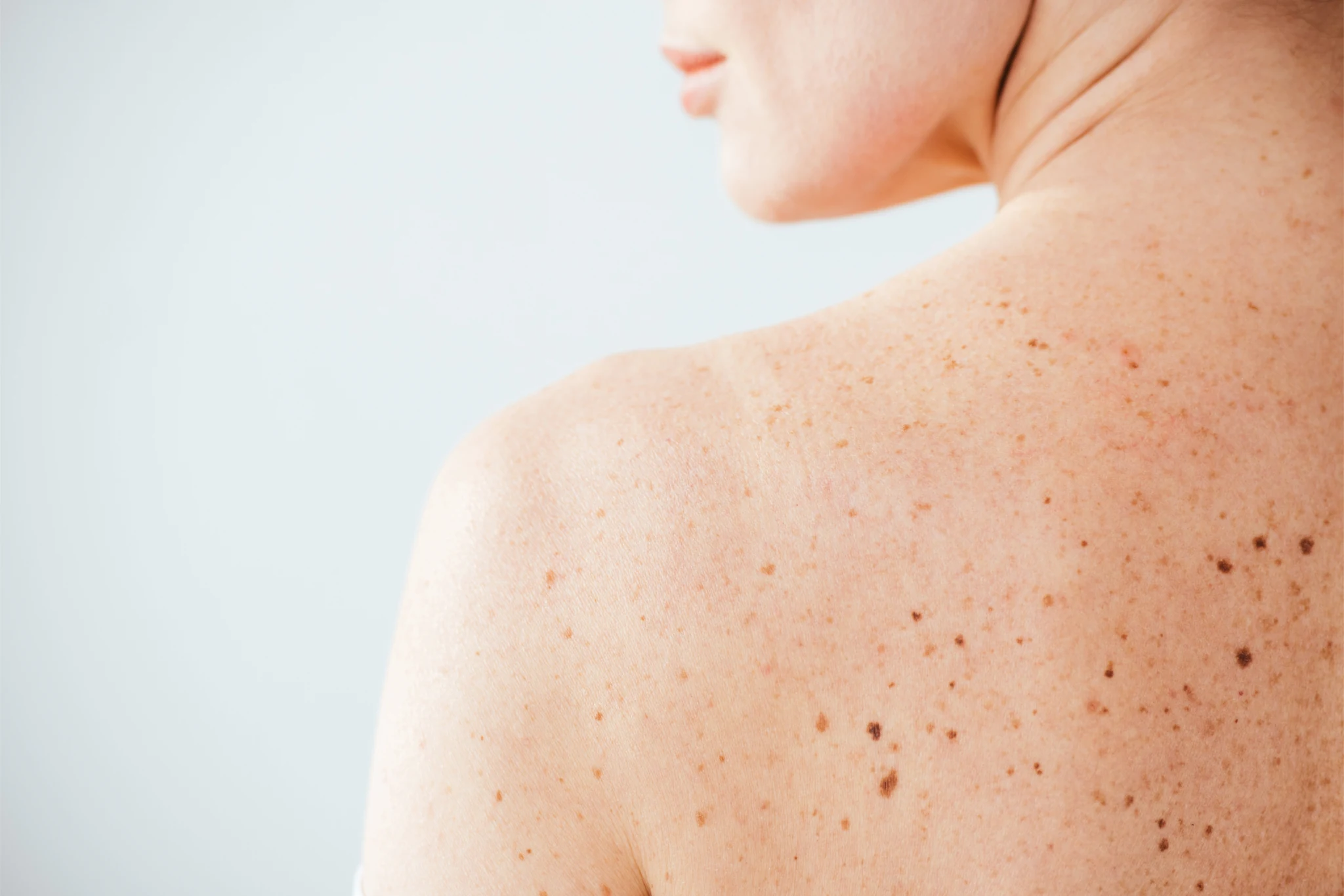 Detalle de piel natural con pecas en el hombro