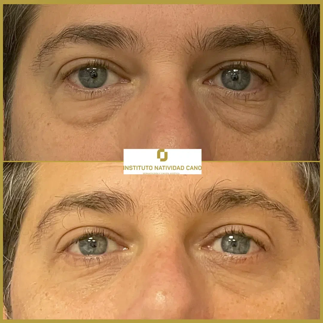Tratamiento mirada-Blefaroplastia Caso 3-F
