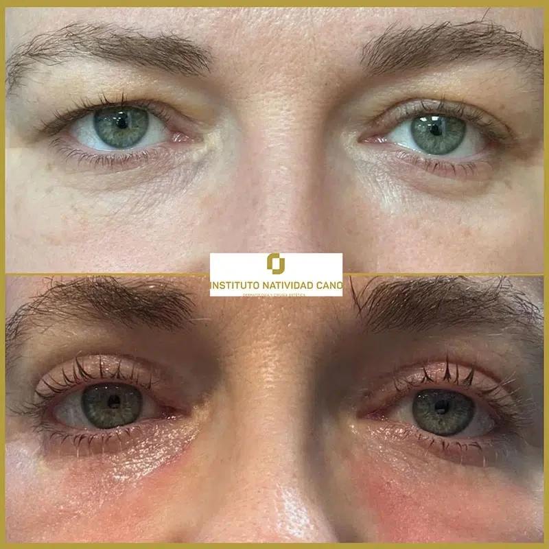 Tratamiento con Láser CO2: rejuvenecimiento facial y eliminación de imperfecciones cutáneas