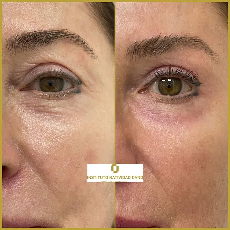 Tratamiento con Láser CO2: rejuvenecimiento facial y eliminación de imperfecciones cutáneas
