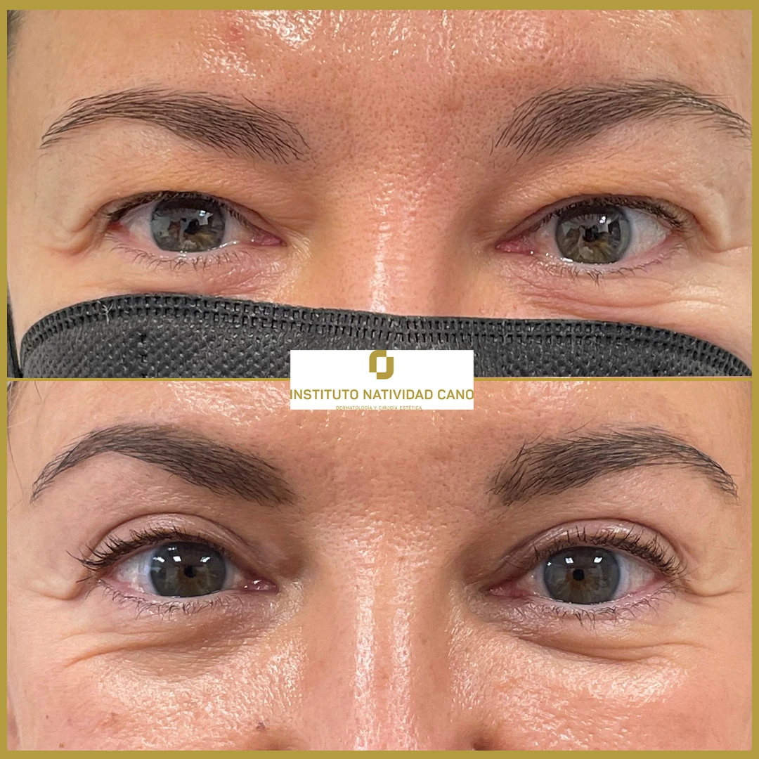 Blefaroplastia superior