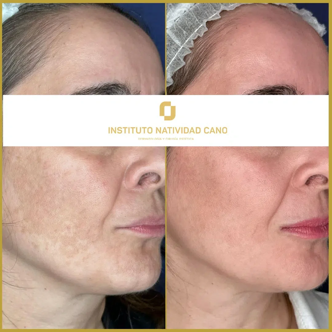 Tratamiento del melasma derecha caso 3