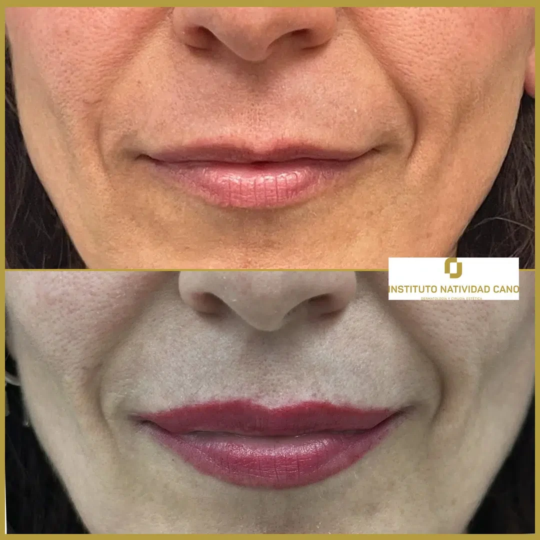 Lip Lift Directo