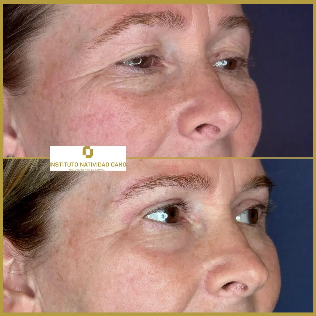 Tratamiento mirada-Blefaroplastia Caso 1-F