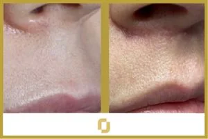 ¿Qué es la cirugía de lip lift?