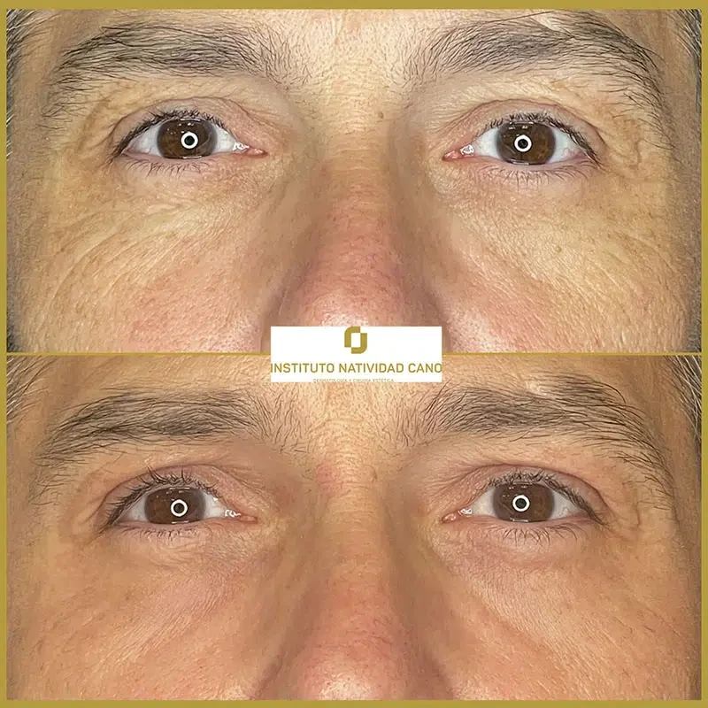 Tratamiento con Láser CO2: rejuvenecimiento facial y eliminación de imperfecciones cutáneas