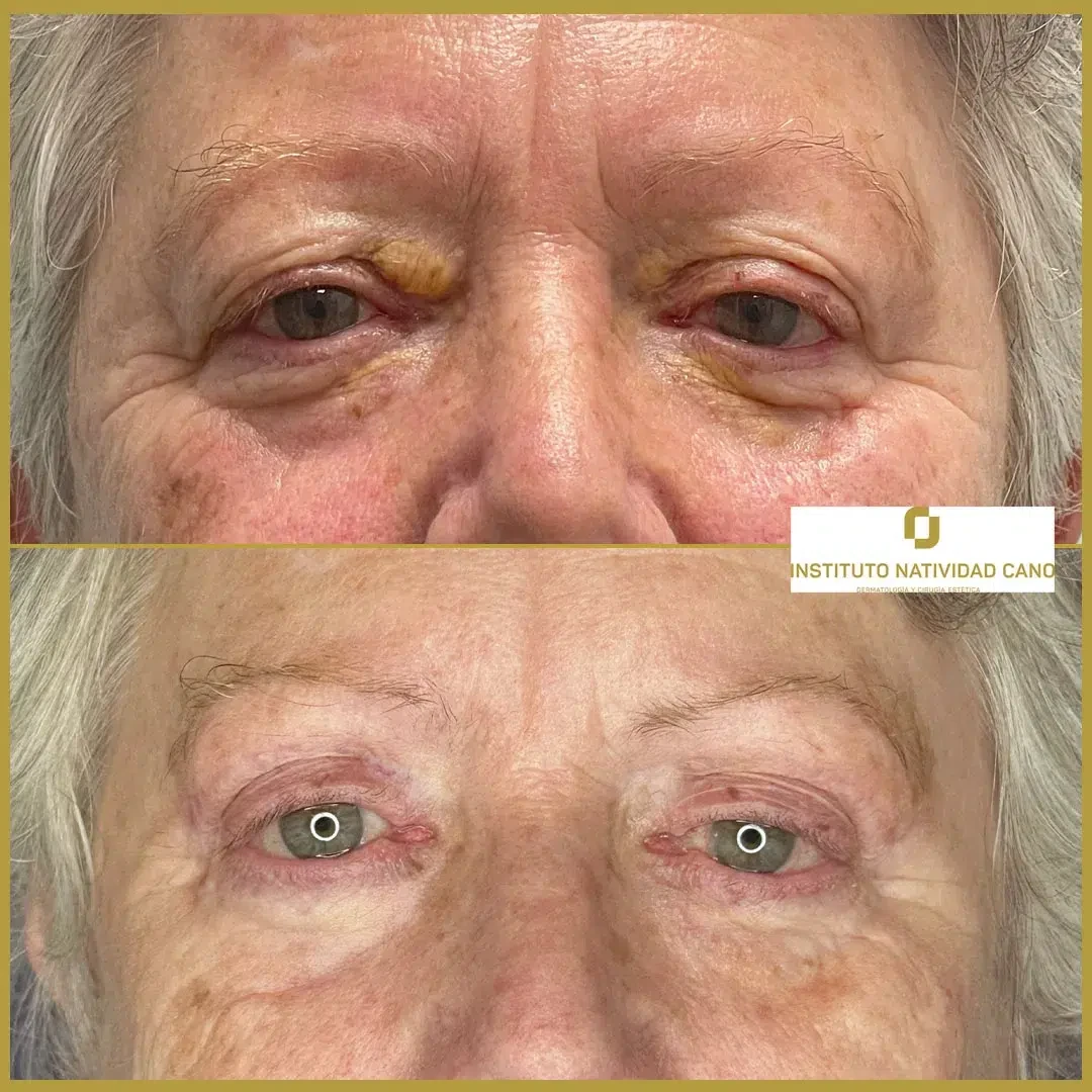 Blefaroplastia superior