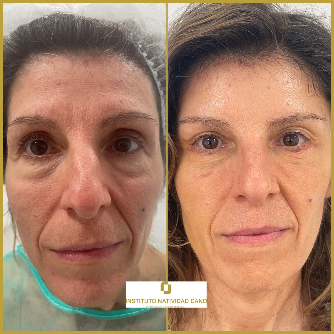 1-BLEFAROPLASTIA-SUPERIOR-Y-LIFTING-DE-CEJAS-Instituto-Natividad-Cano