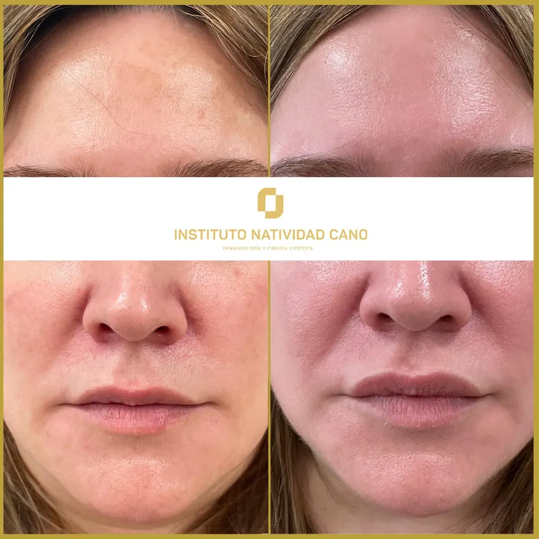 Tratamiento del melasma frente caso 2