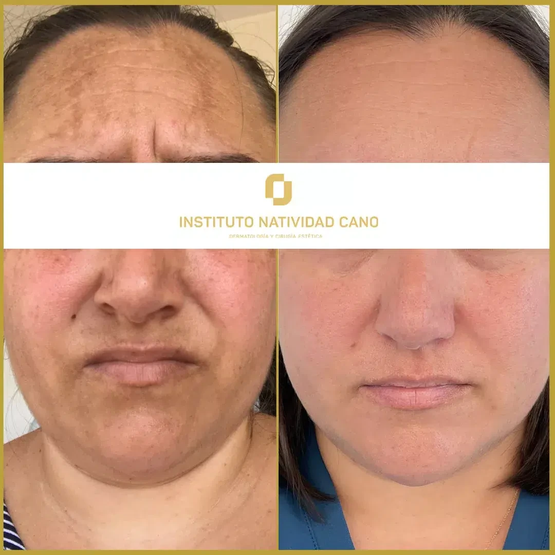 Tratamiento para el melasma - piel sana