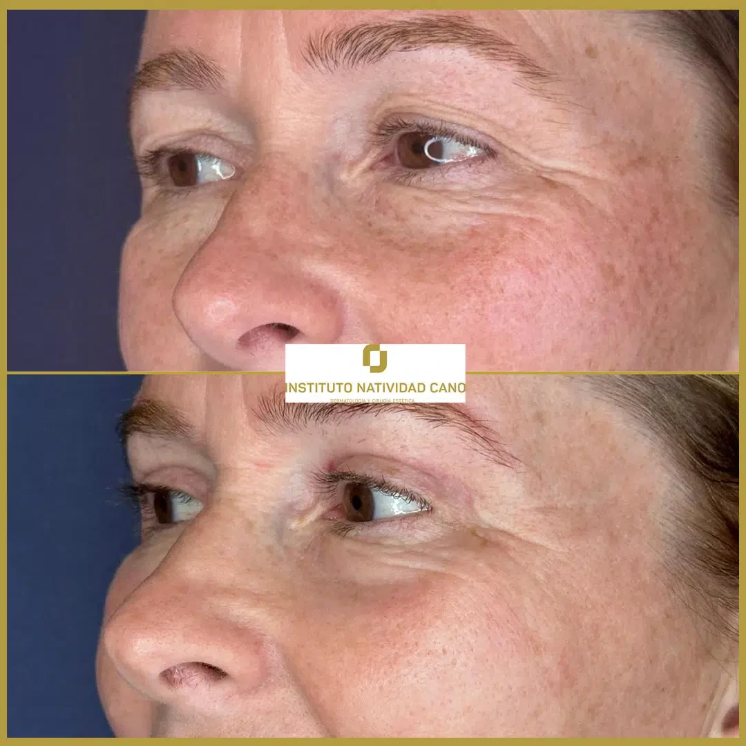 Tratamiento mirada-Blefaroplastia Caso 1-i