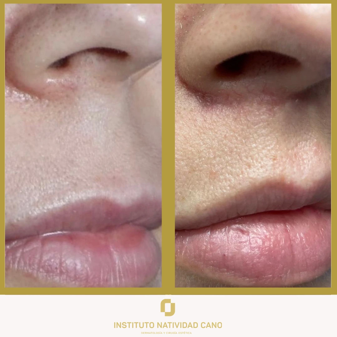 Lip Lift