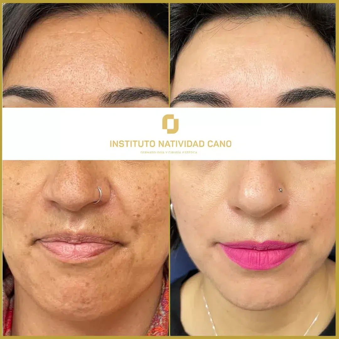 Tratamiento para el melasma - piel sana