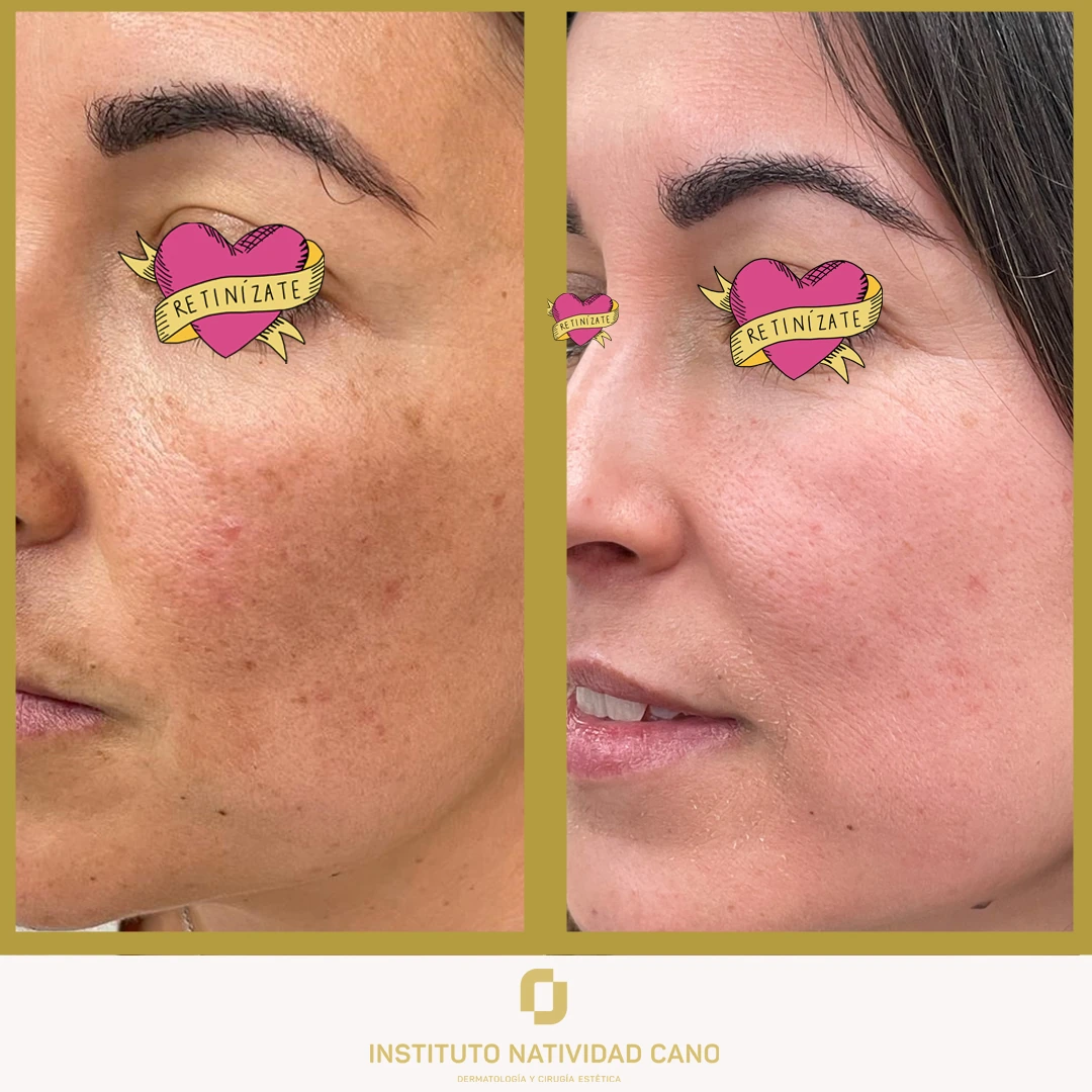 Melasma