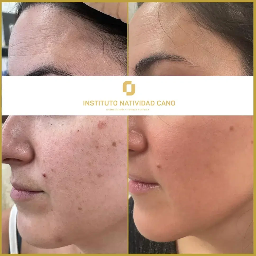 Tratamiento para el melasma - piel sana