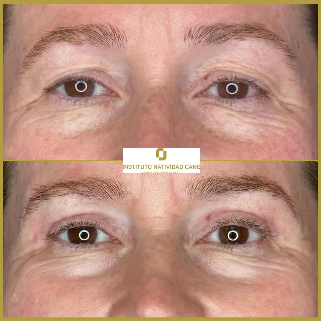 Tratamiento mirada-Blefaroplastia Caso 1-F